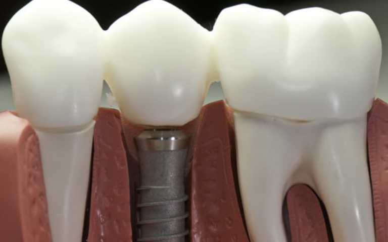 Dental Implants