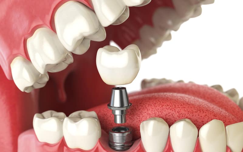 livonia dental implants