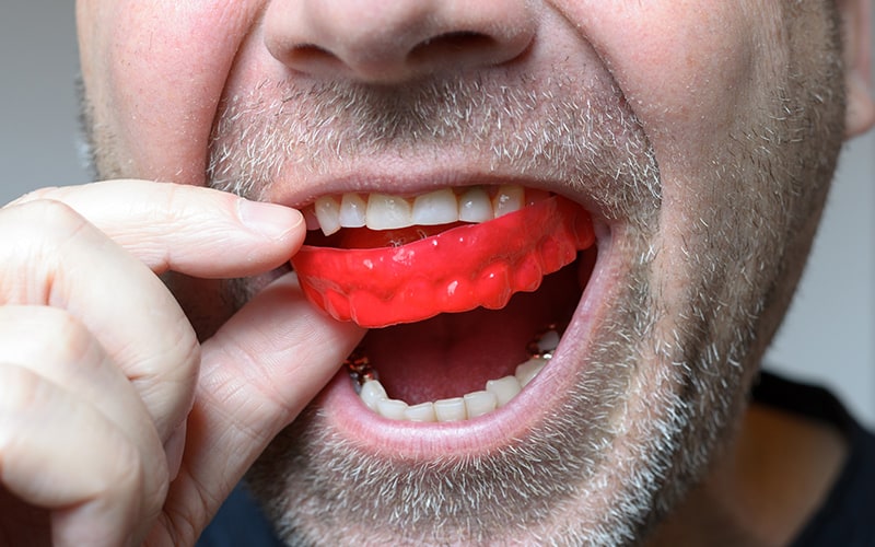 mouth guards and night guards in livonia