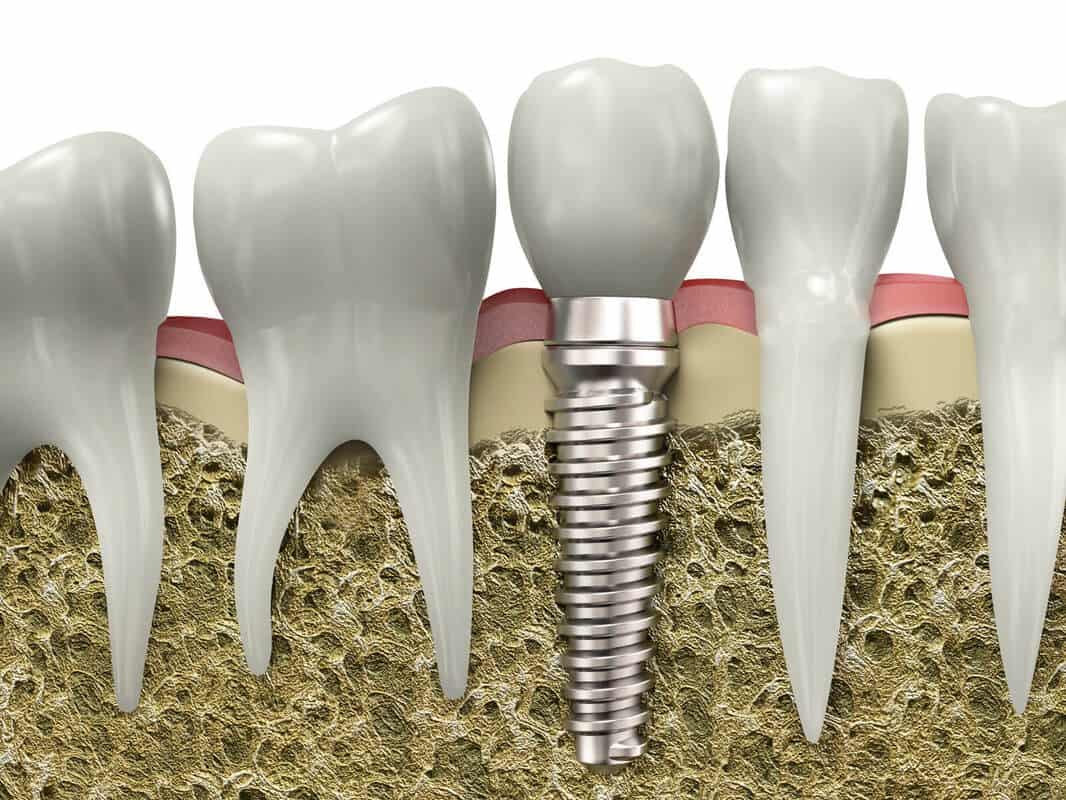 need to know about getting dental implants