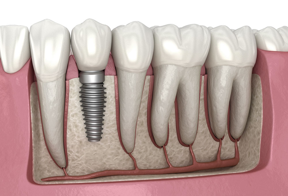 know about the two main types of dental implants