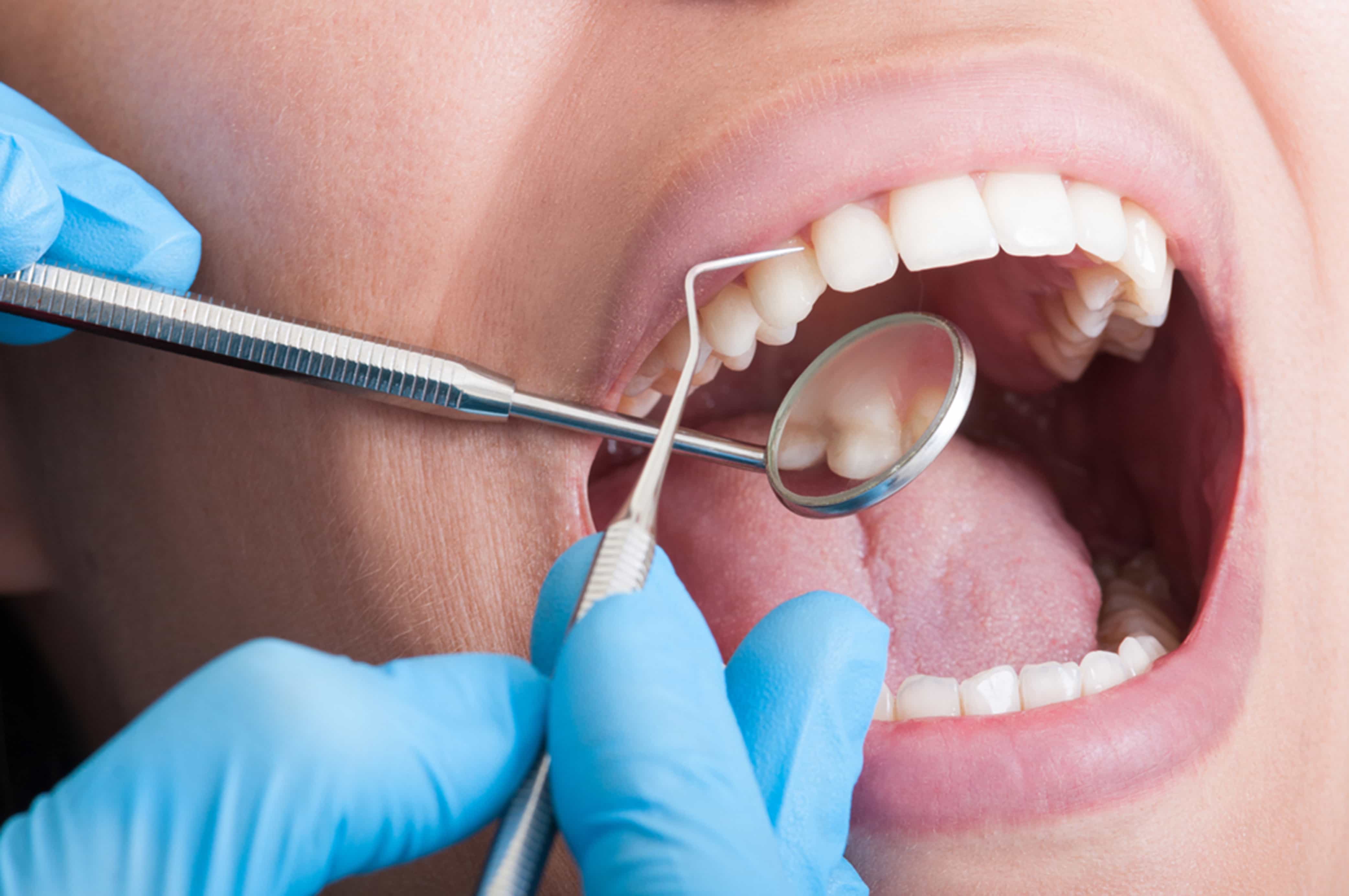 what is the lifespan of a root canal therapy