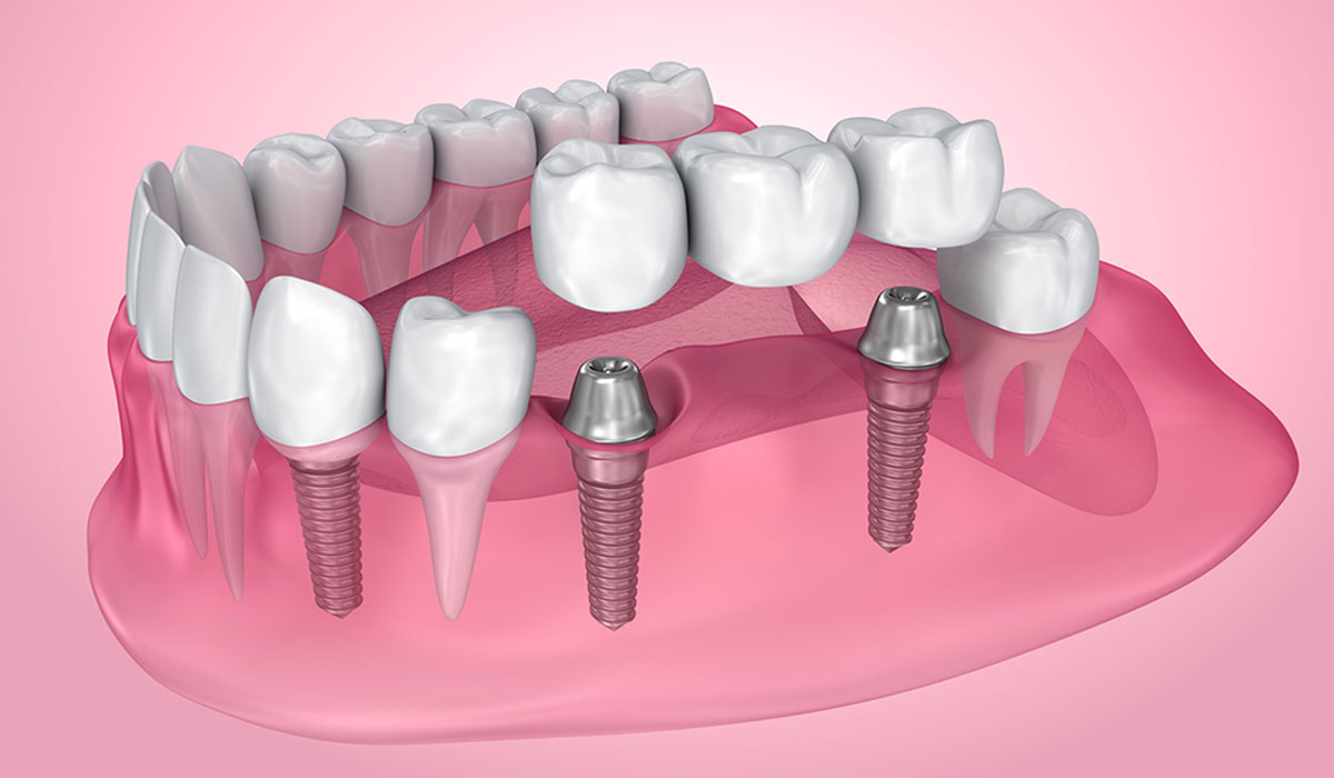 facts about dental implants