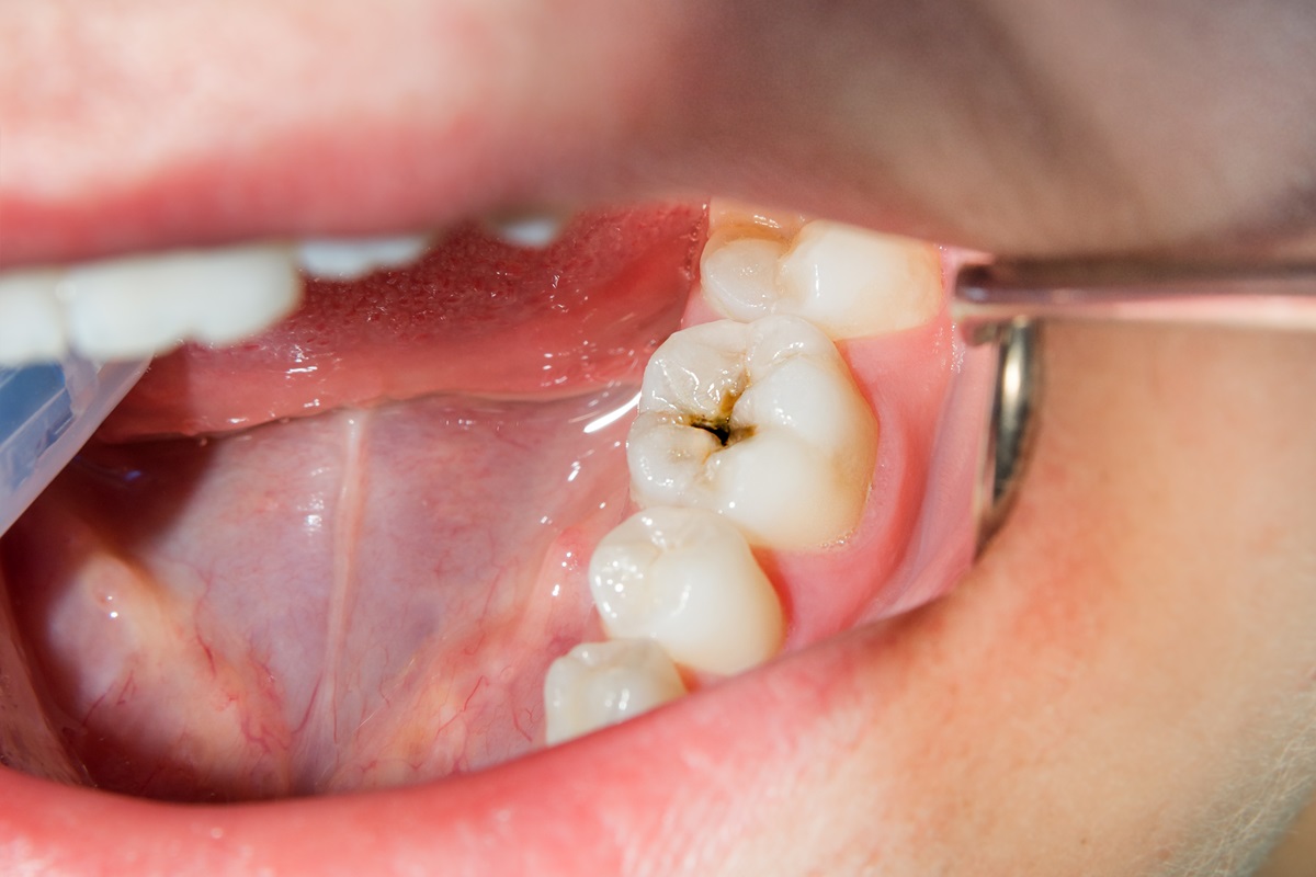 early detection of cavities a comprehensive oral examination for tooth decay