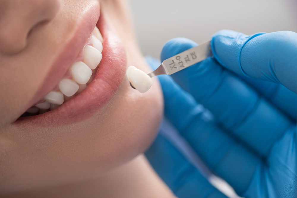 how dental crowns can transform your teeth