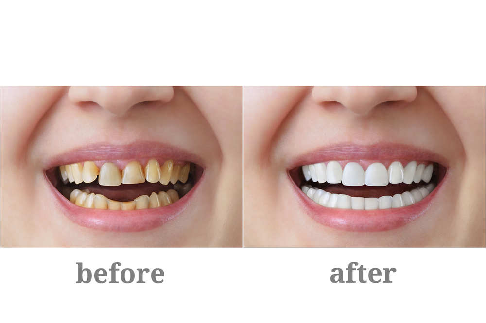 dental crown in Livonia